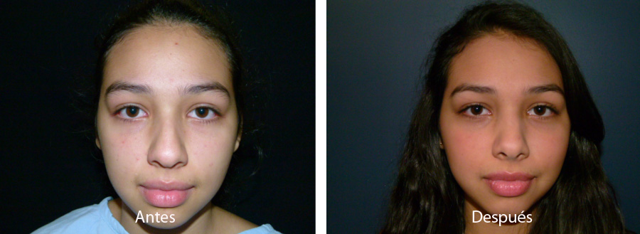 rinoplastia43