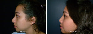 rinoplastia44