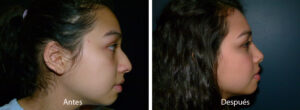 rinoplastia45