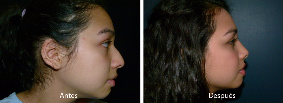 rinoplastia45
