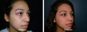 rinoplastia46