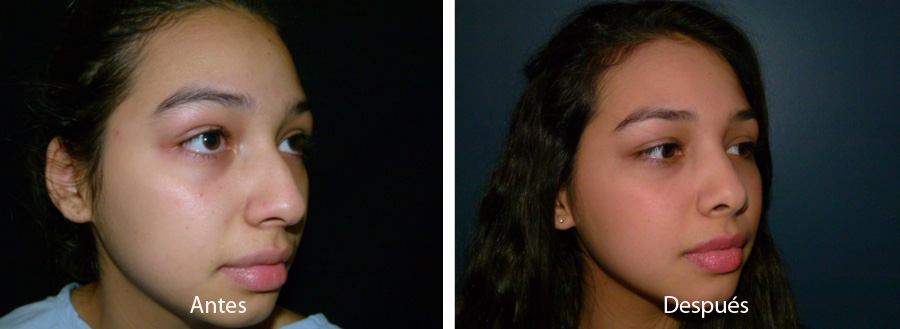 rinoplastia46