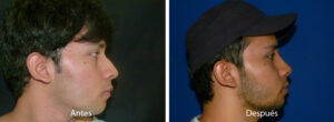 rinoplastia49