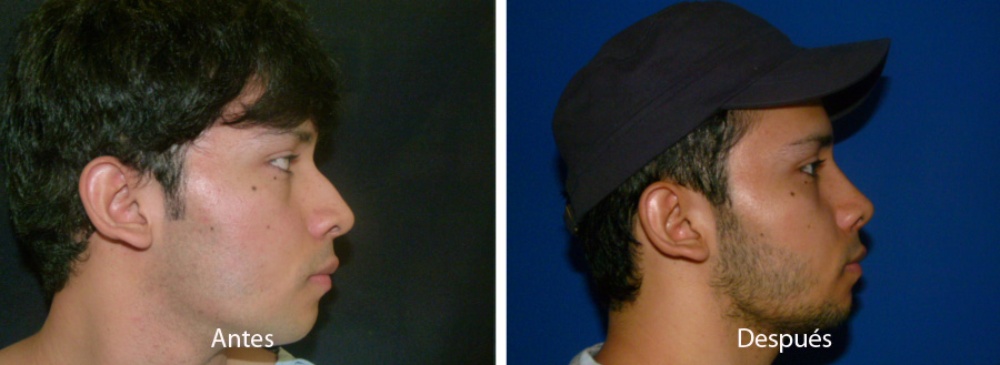 rinoplastia49