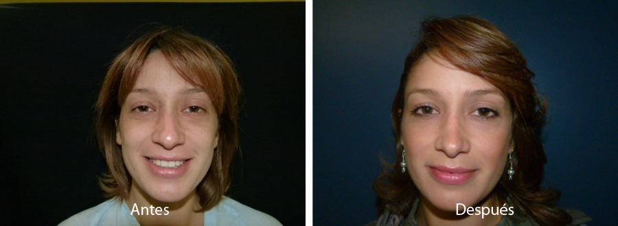 rinoplastia50