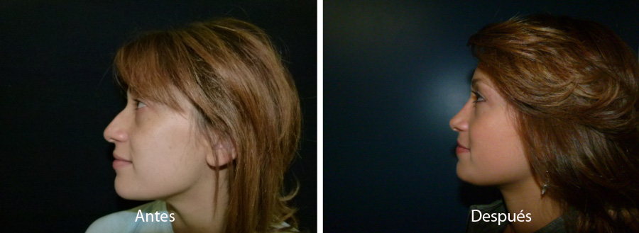 rinoplastia52