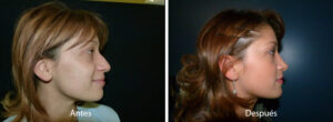 rinoplastia53