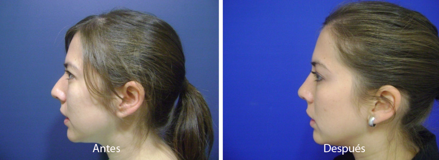 rinoplastia7
