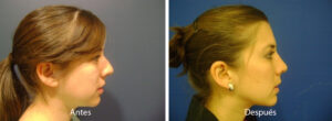 rinoplastia8