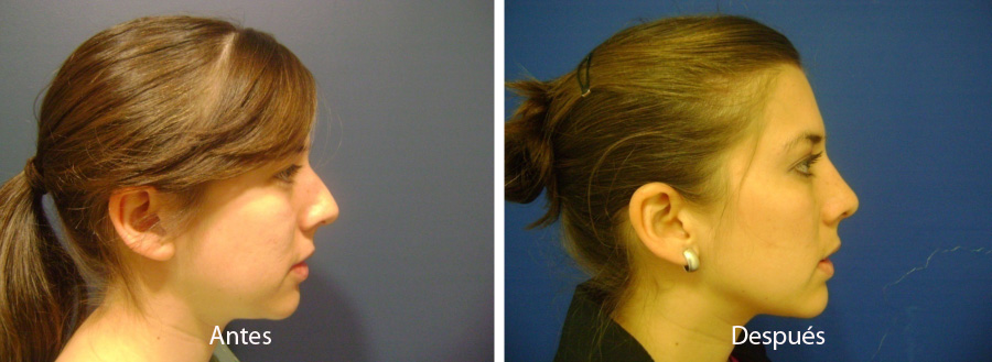 rinoplastia8