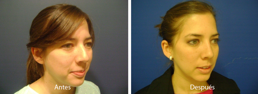 rinoplastia9