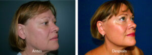 ritidoplastia-5