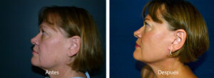 ritidoplastia-6