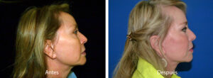 ritidoplastia16