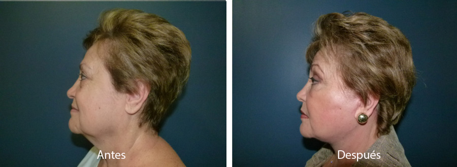 ritidoplastia19
