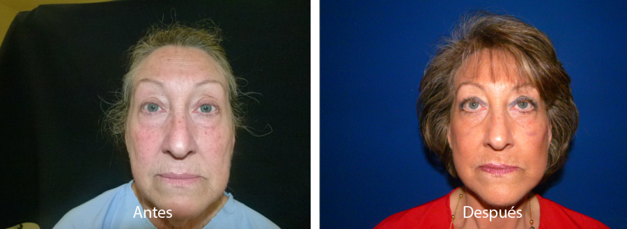 ritidoplastia23