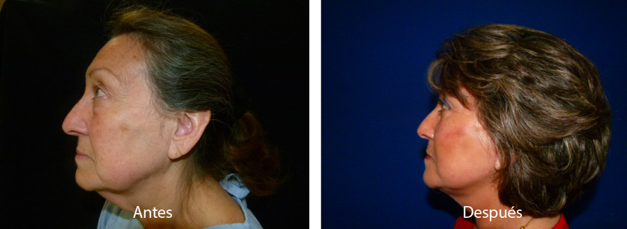 ritidoplastia25