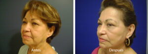 ritidoplastia29